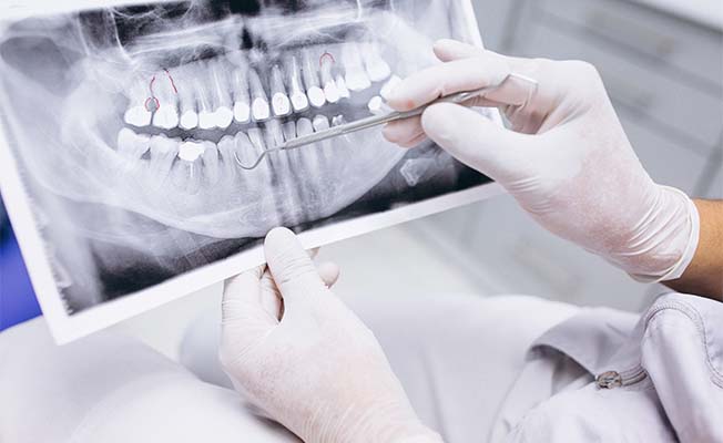 Sigara, diş tedavi sürecini olumsuz etkiliyor